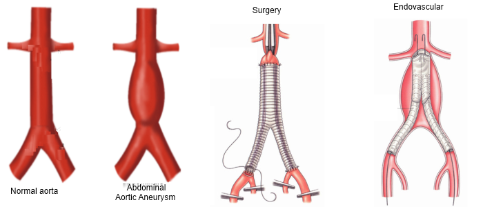 aneurismas de aorta