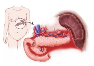 aneurismas-de-otras-localizaciones
