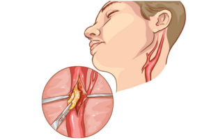 estenosis-carotídea