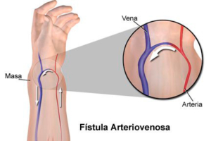 fistula-dialisis