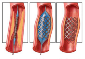 isquemia-de-miembros