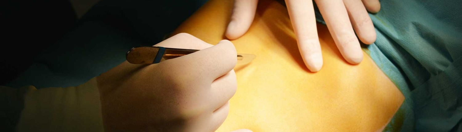 isquemia mesentérica