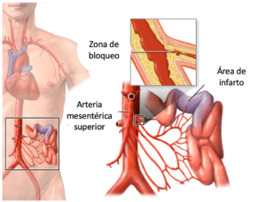 isquemia-mesentérica