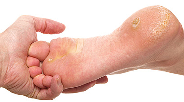Dry skin under foot
