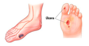 pie-diabético