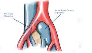 síndromes-compresivos-abdominales