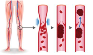 trombosis-venosa-profunda