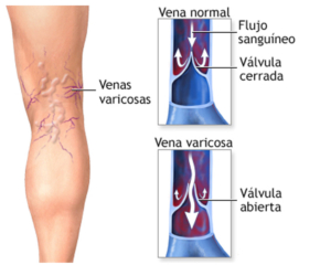 varices